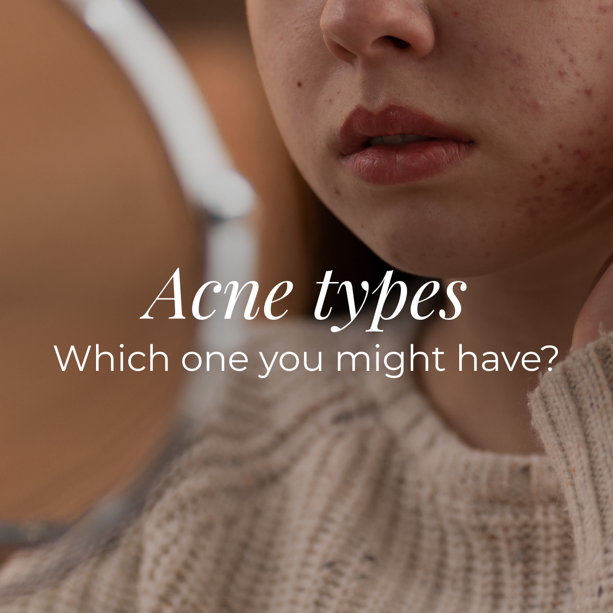 Acene Types Acne types and which one you might have – NOURISHED3 EU